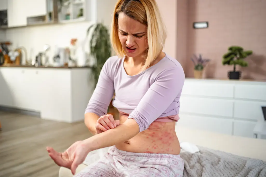 Can mold cause hives Lakewood Ohio 4